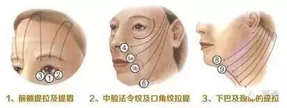 脸部缝美容线好还是普通线好,医院埋线和美容院埋线有什么差别