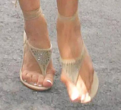 贝克汉姆老婆脚外翻,贝克汉姆老婆的脚拇外翻