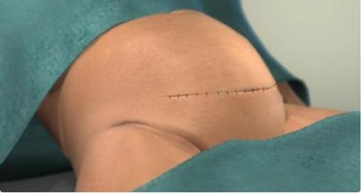 给孩子看的剖腹产手术全部流程,剖腹产手术最详细的介绍