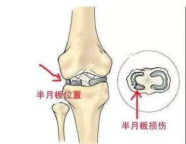 关于半月板损伤的患者12个经典问题解答
