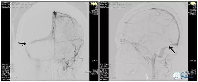 脑静脉窦狭窄做支架危险吗,静脉窦狭窄做支架后多久恢复