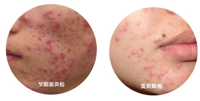 战痘合集完整版,战痘大结局完整版