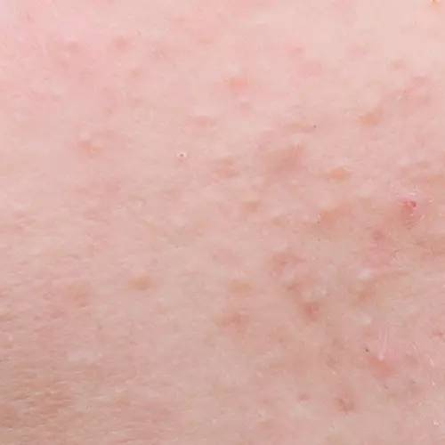 十年战痘血泪史详解,战痘知识分享