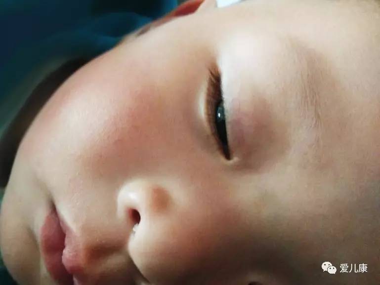 8岁睡觉眼睛闭不严是什么原因,睡觉眼睛闭不严对眼睛有危害吗