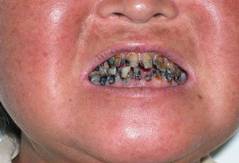 爸妈说你“二天”一定要得的这种病，到底是个啥子病？