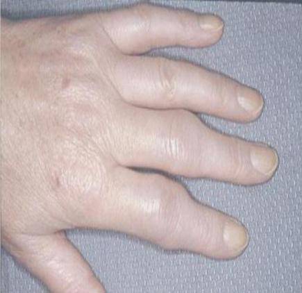 爸妈说你“二天”一定要得的这种病，到底是个啥子病？