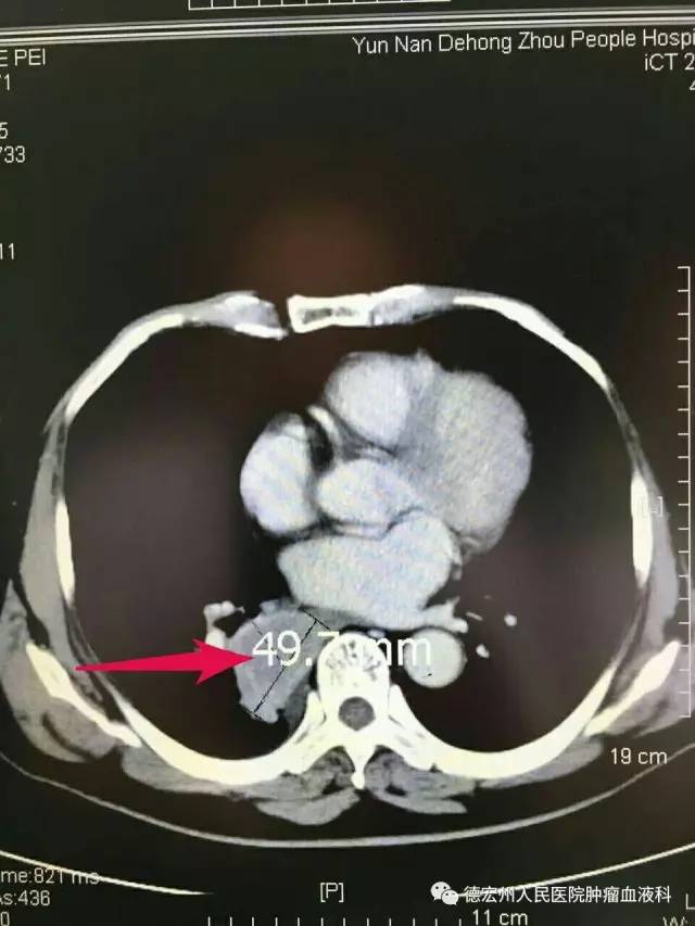 云南德宏中草药治癌,云南肿瘤医院治疗癌症