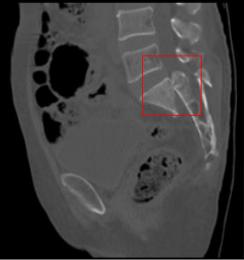 12胸椎爆裂性骨折截瘫恢复案例,一位阿姨因为骨折瘫痪多年