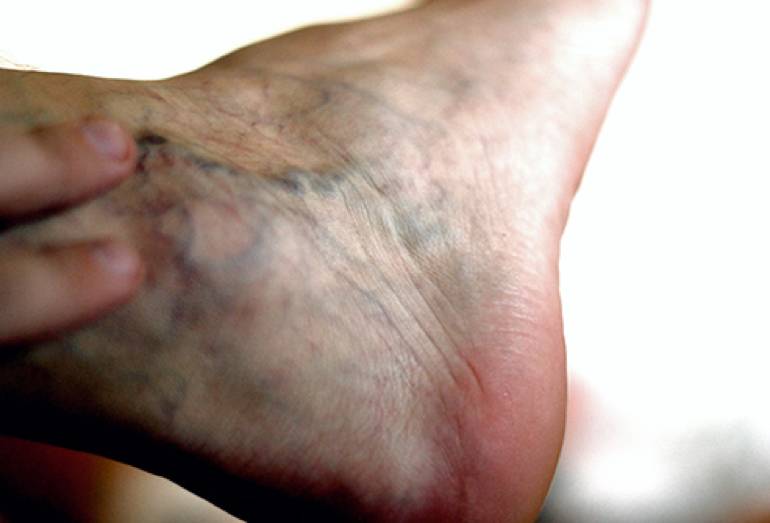 为什么脚肿了晚上特别疼,为什么坐久了腿肿脚肿