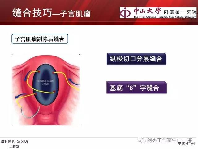妇科腹腔镜下常用缝合技巧