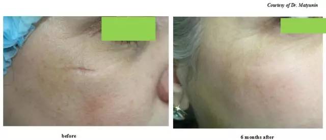 徐医附院美容中心整形案例,徐医附院整形美容中心祛痣