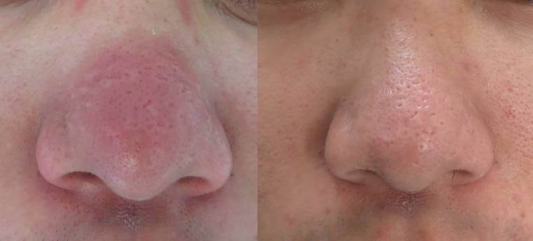 激光祛闭口痘痘,闭口粉刺可以做激光祛痘吗