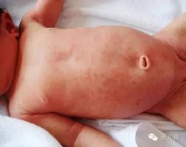 专家在线丨高烧?出疹?腹泻?让家长如临大敌的幼儿急疹,原来是这么一回事!