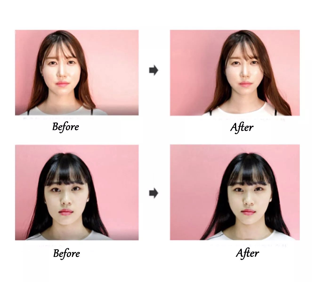 医学瘦脸的方法有哪些不打针,瘦脸除了打针还可以有什么方法