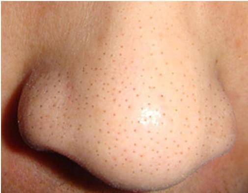 黑头反反复复去不掉,黑头老是反复怎么去解决