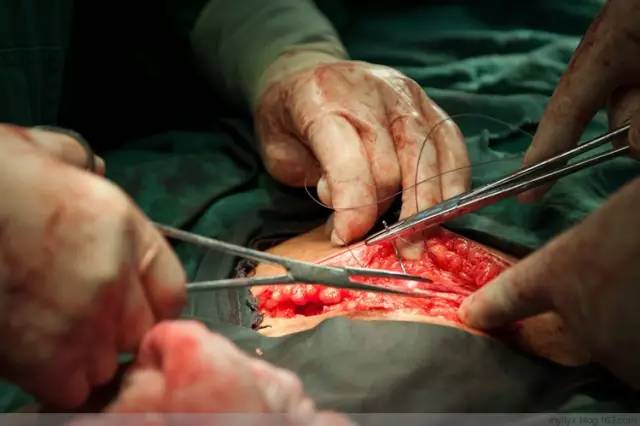 剖腹产全景记录,剖腹产恢复不同时期的照片