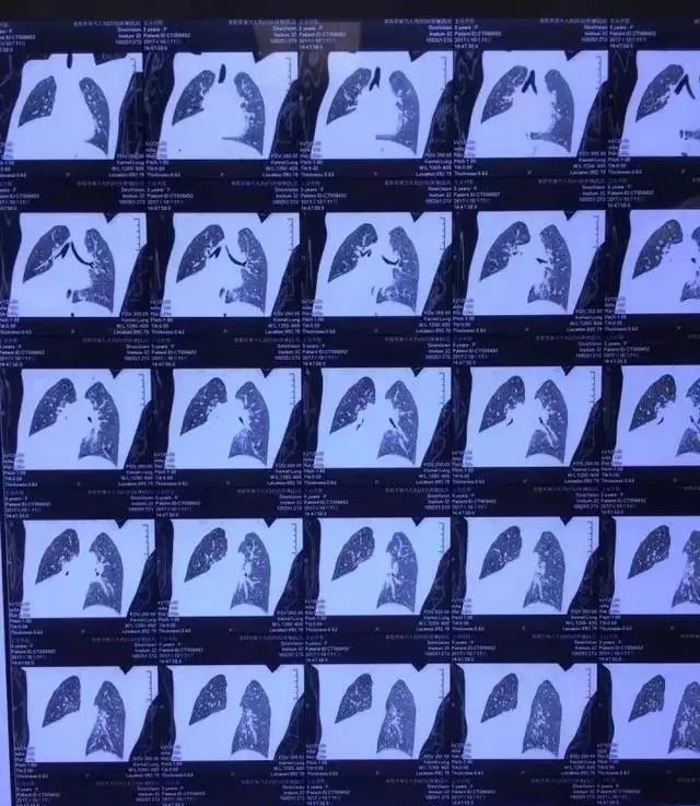 5岁小孩咳嗽了两个月了总是不好,6岁女童咳嗽要如何治疗