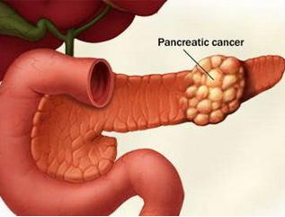 死于胰腺癌的名人,死于胰腺癌症的名人