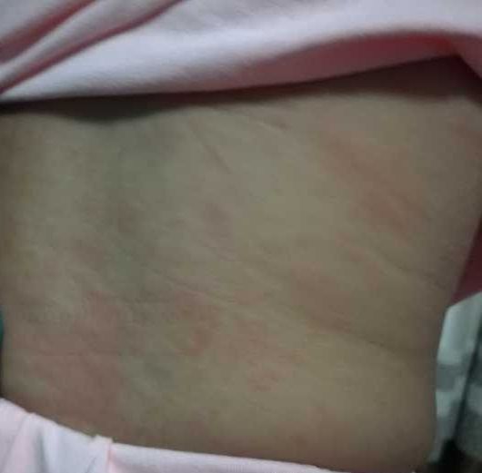 幼儿急疹9个月去医院要打针吗,9个月宝宝急疹的处理