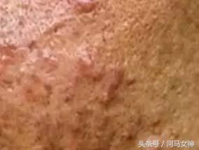 抗痘填坑,抗痘期间忌口大全