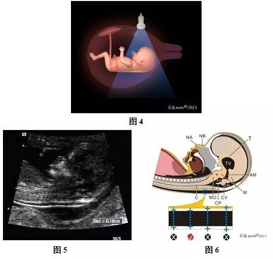 孕26周进行胎儿超声心动图检查,孕11-14周胎儿超声检测报告