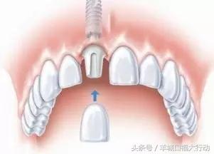 拔牙后可以直接镶牙吗,镶牙拔牙理论知识