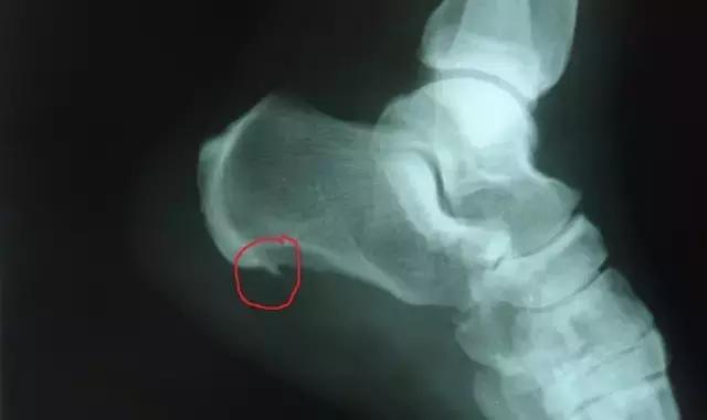 长了骨刺自己慢慢会自愈吗,脚跟长骨刺会引起哪些症状