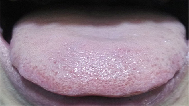 舌头有什么病检查什么,舌头有问题是怎么回事