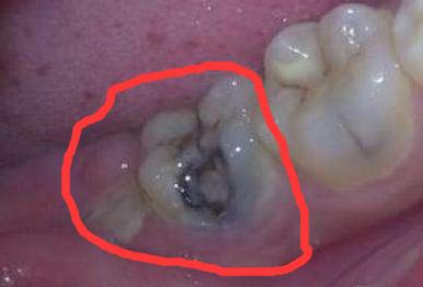 牙龈肿痛怎么治疗最好,治疗牙龈肿痛的中药方