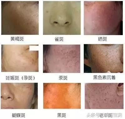 祛斑攻略各类色斑问题解决,祛斑先识斑辨证治斑方法多
