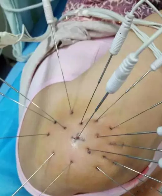 内热针是全针发热还是针尖发热,浮针治疗颈肩腰腿痛怎么样