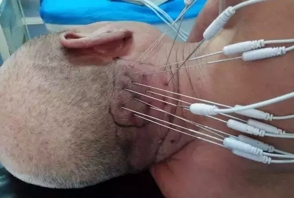 内热针是全针发热还是针尖发热,浮针治疗颈肩腰腿痛怎么样