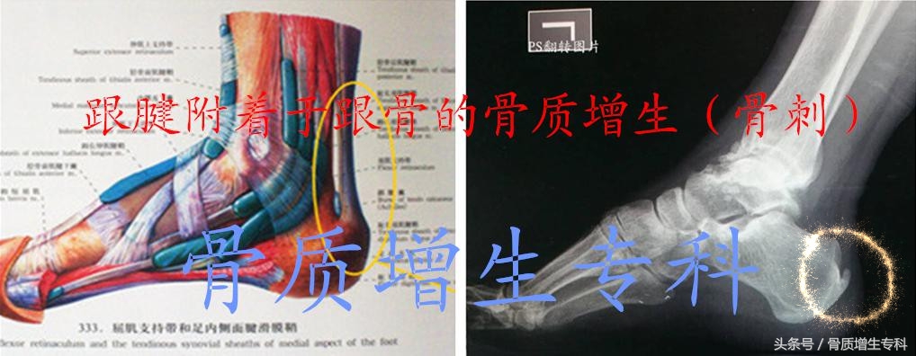 脚跟骨质增生,最全解析(含锻炼方法和防、治)