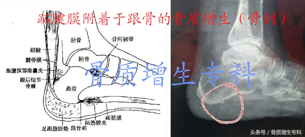 腰椎曲度变直并骨质增生怎么锻炼,颈椎间盘突出加骨质增生锻炼方法