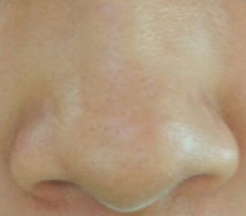 鼻子上挤出的白色条状物到底是啥,鼻子两边能挤出白色东西的是什么