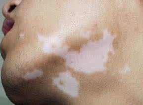 白癜风治疗出现瓶颈,多位白癜风专家“三顾茅庐”请出老中医,与其一起研究白癜风的治疗方法,成果惊人