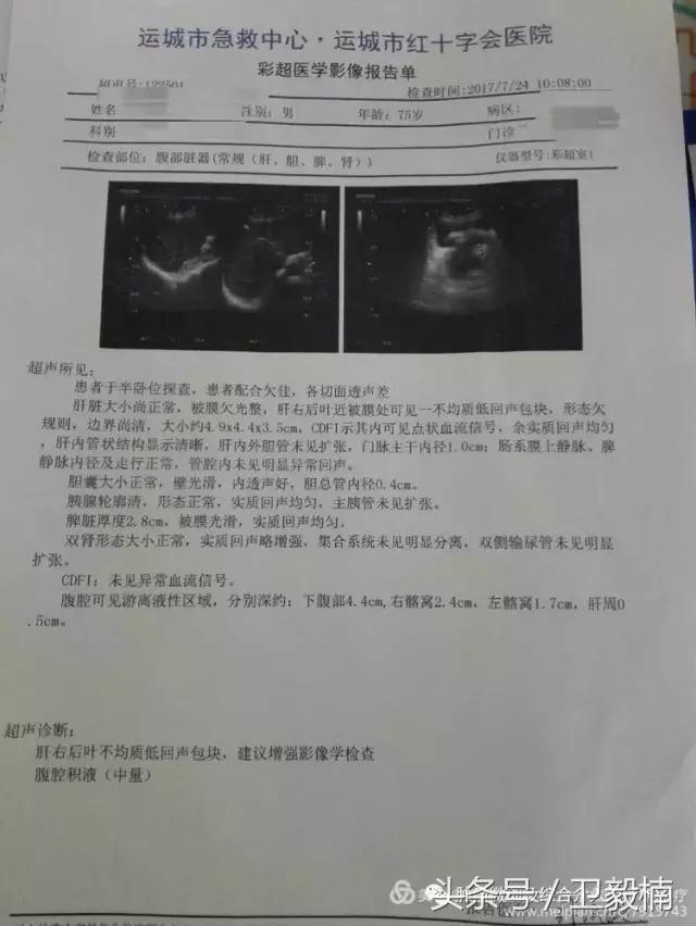 近日运城市第一医院肿瘤微创及介入治疗中心行肝癌破裂急诊行介入栓塞治疗术后患者出血停止腹痛减轻