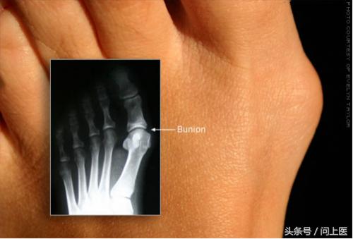 脚气如何根治图片,脚气病治疗好办法