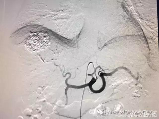 近日运城市第一医院肿瘤微创及介入治疗中心行肝癌破裂急诊行介入栓塞治疗术后患者出血停止腹痛减轻