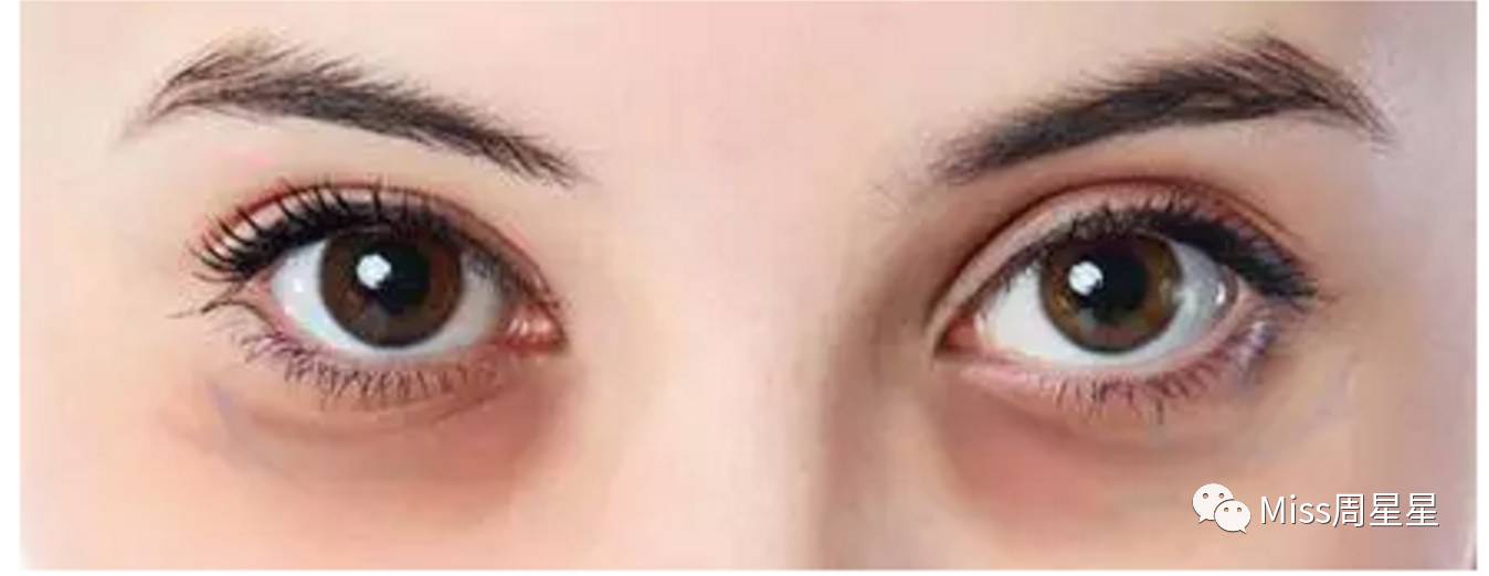 千年黑眼圈解决方案,万年黑眼圈有救的吗