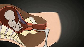 五个月无痛引产跟一般引产的区别,迫不得已做引产