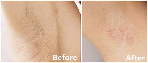 全球顶级脱毛膏,一款很牛的脱毛膏