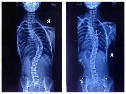 针灸治疗脊柱侧弯的最好方法,脊柱侧弯如何治疗才正确有效