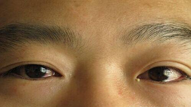 眼屎是身体在自愈吗,眼屎里到底含有什么