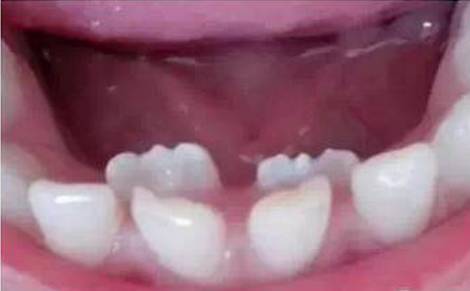 小孩长了双排牙要不要拔,孩子长出双排牙要立即拔吗