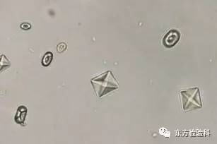 尿中结晶达到多少就是结石了,尿结晶数高是病吗