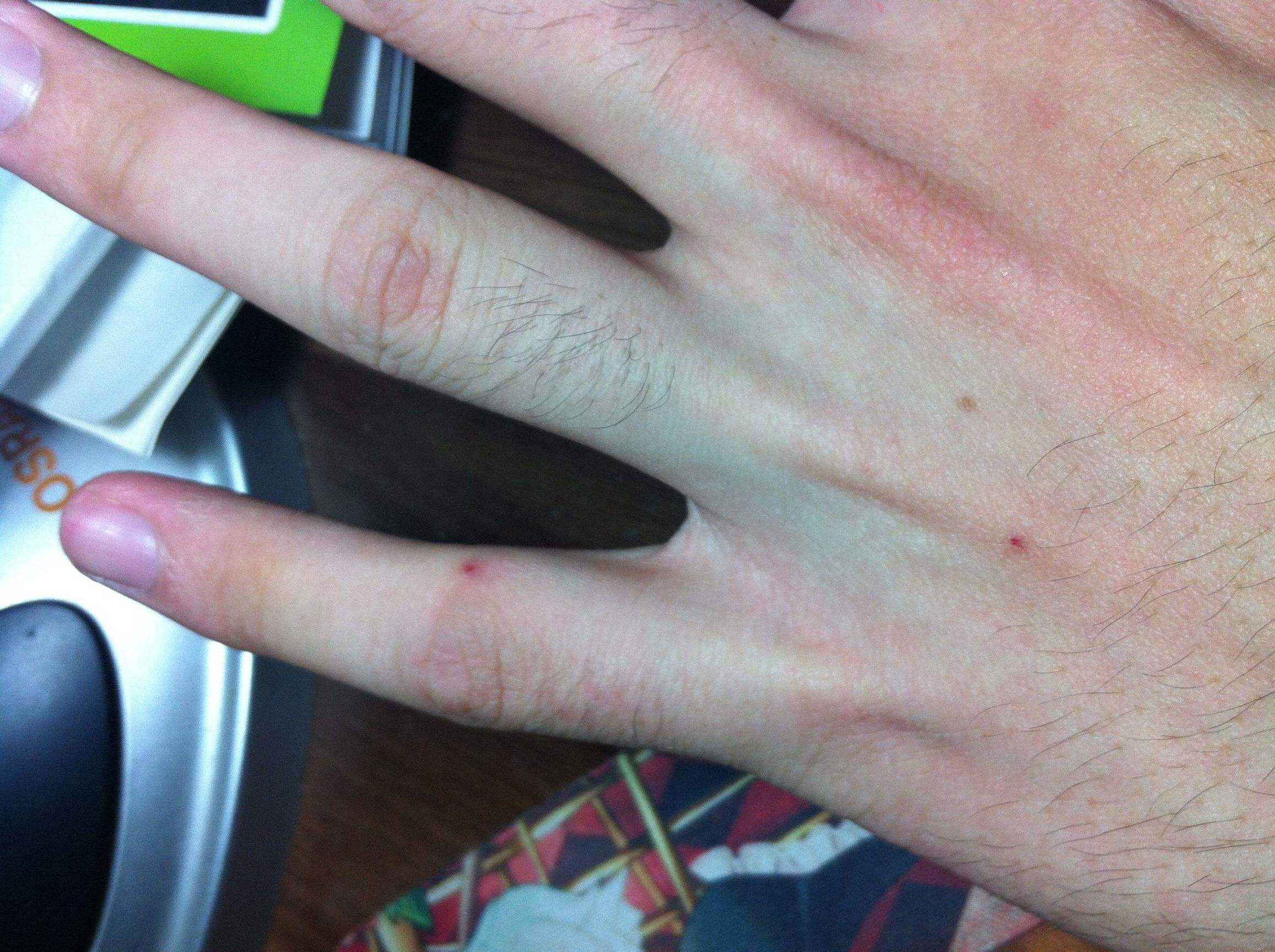 有像痣一样的小红点不痛不痒,身上长小红点像小白点