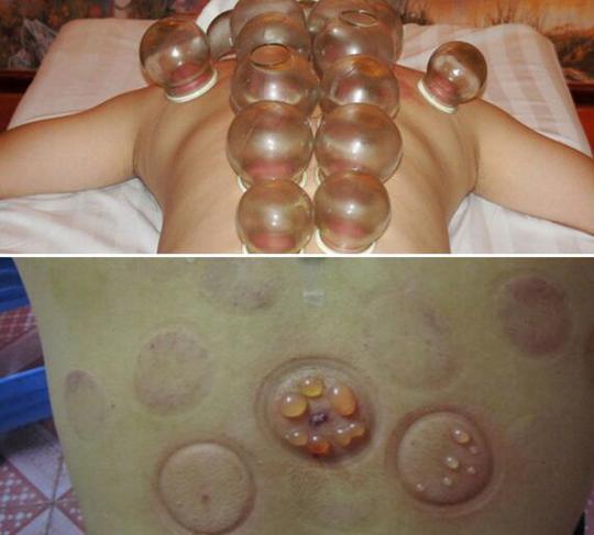 拔火罐出水泡是体内湿气重了吗,拔火罐有水泡湿气重怎么调理