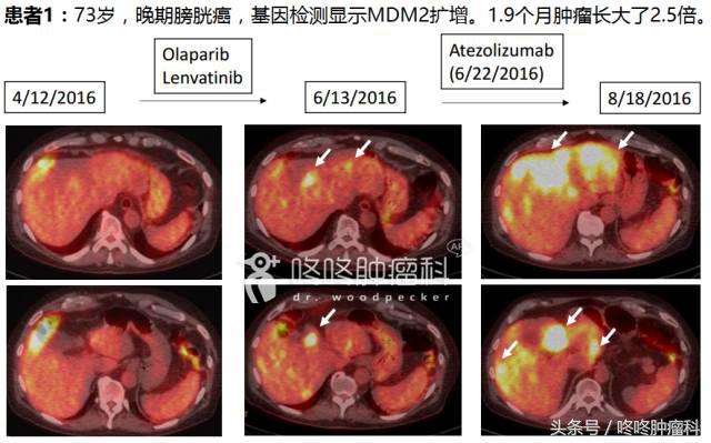 怎样知道pd-1治疗有效,怎么判断pd1免疫治疗有效