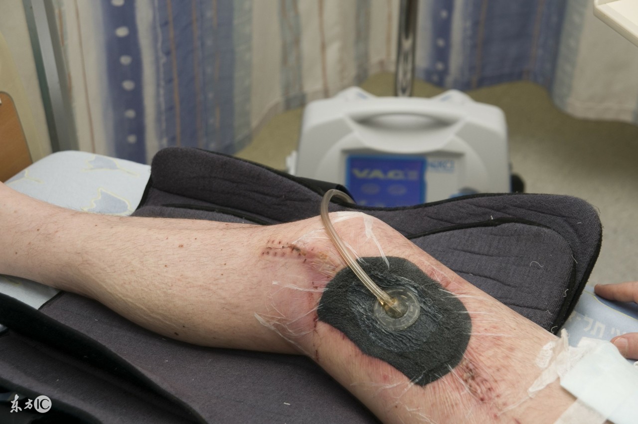 vsd负压引流创面散发臭味,vsd负压吸引术促进创面愈合